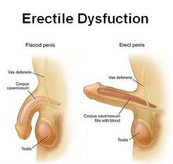 Erectile-Dysfunction-pictures