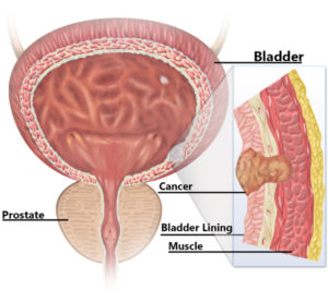 Bladder cancer is estimated to result in more than 15,000 deaths in the U.S. in 2014. Muscle-invasive bladder cancer is the deadliest type of the disease.